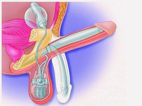 Ampliación do pene mediante prótese de pene